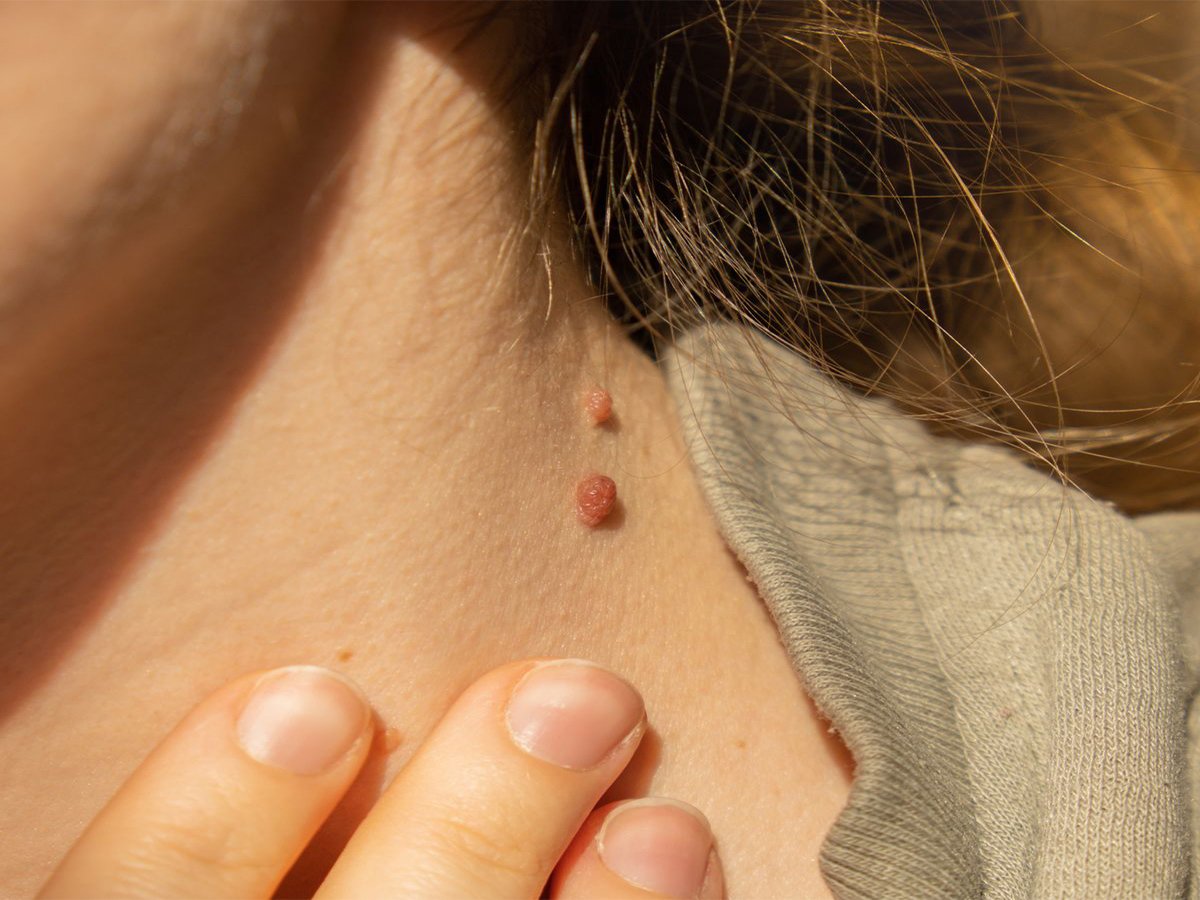 Skin Tag, Wart & Mole Removal